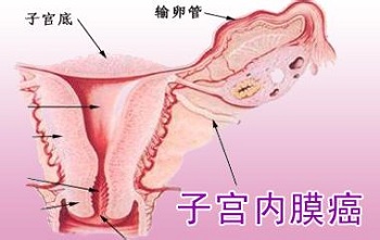 中医治疗肿瘤最好的医院知病因子宫癌康复